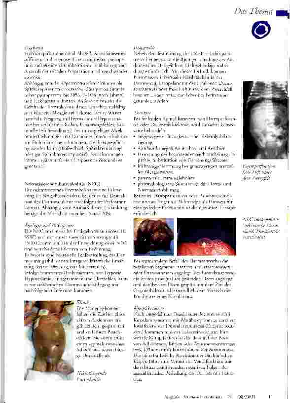 Vorschauseite 3: Enterostoma bei angeborenen und frühkindlich erworbenen Darmerkrankungen