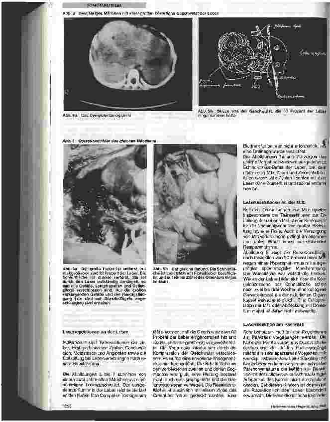 Vorschauseite 4: Laser in der Kinderchirurgie