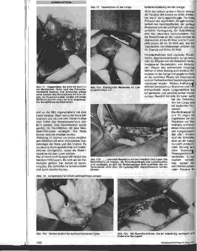 Vorschauseite 6: Laser in der Kinderchirurgie