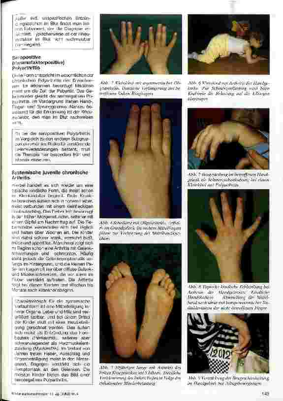 Vorschauseite 2: Juvenile chronische Arthritis Klinische Aspekte