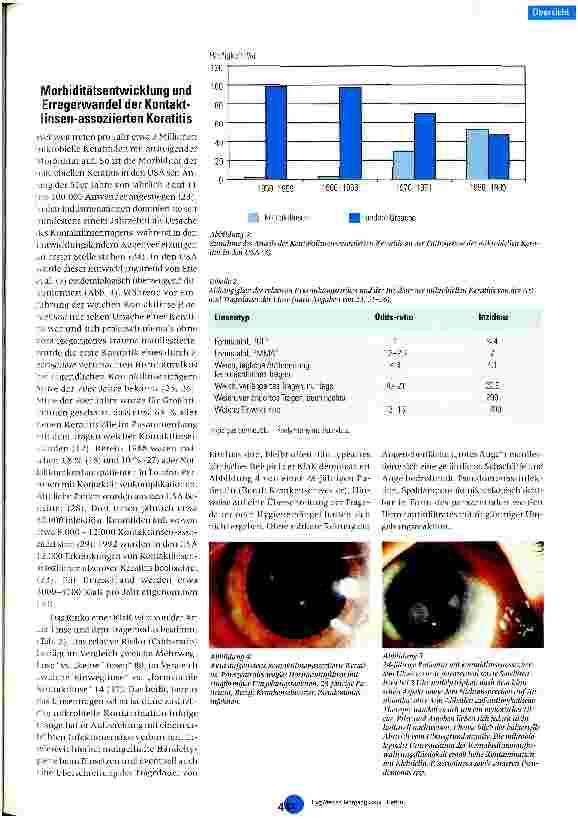 Vorschauseite 4: Häufigkeit, Ursachen und Prävention der Kontaktlinsen-assoziierten infektiösen Keratitis