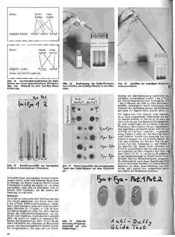 Vorschauseite 5: Transfusionskunde, Blutgruppenserologie und Immunhämatologie 19. Folge: Vererbung und Bestimmung seltener Blutgruppensysteme