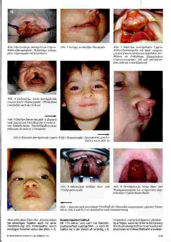 Vorschauseite 2: Spaltbildungen des Gesichtes Chirurgische Therapie der Lippen-Kiefer- Gaumenspalten, Mundspalten und schrägen Gesichtsspalten ... interdiszip
