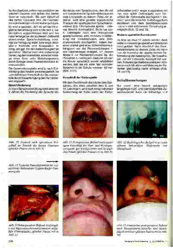 Vorschauseite 3: Spaltbildungen des Gesichtes Chirurgische Therapie der Lippen-Kiefer- Gaumenspalten, Mundspalten und schrägen Gesichtsspalten ... interdiszip
