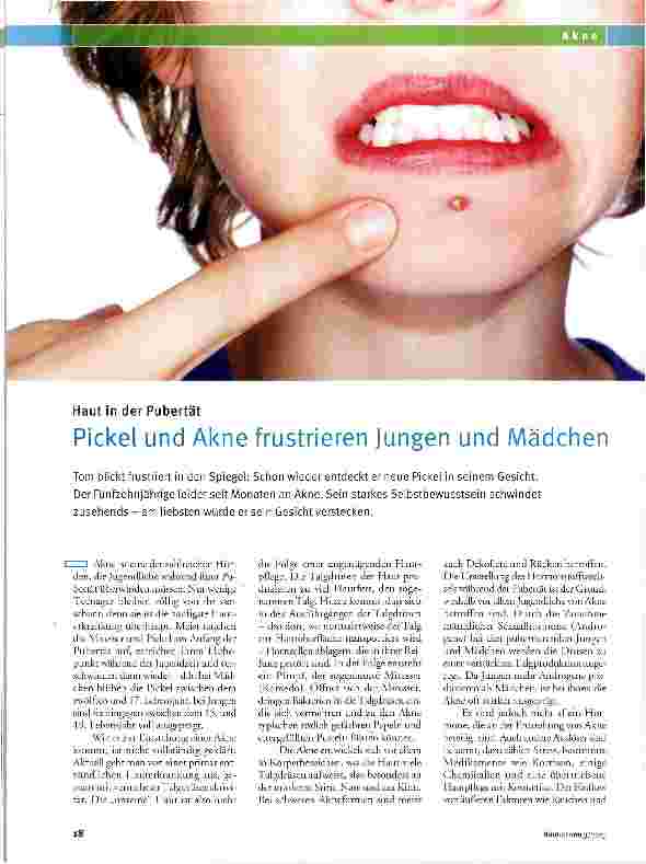 Vorschauseite 1: Pickel und Akne frustrieren Jungen und Mädchen