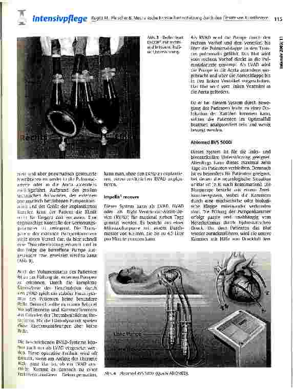 Vorschauseite 4: Mechanische Kreislaufunterstützung durch den Einsatz von Kunstherzen