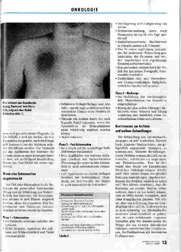Vorschauseite 3: Wie ein Paravasat verhindert werden kann Verabreichen von Zytostatika