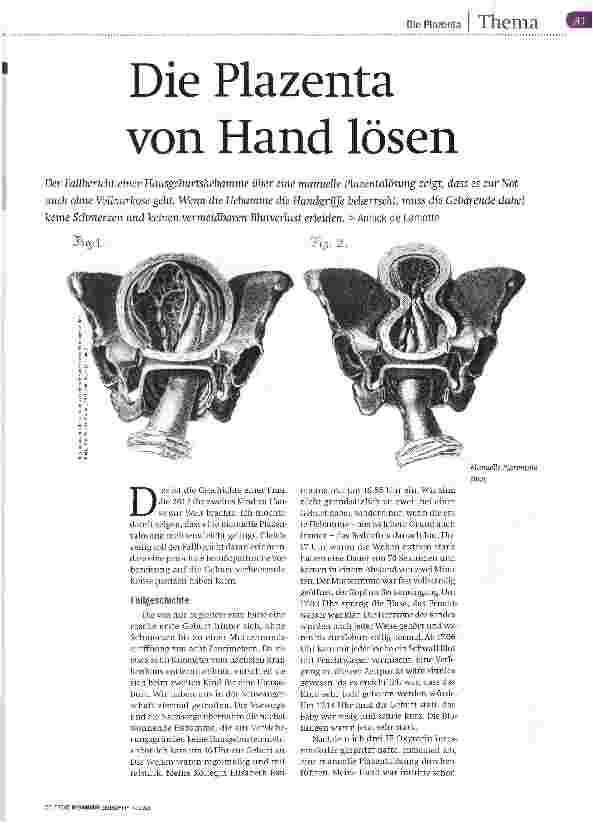Vorschauseite 1: Die Plazenta von Hand lösen