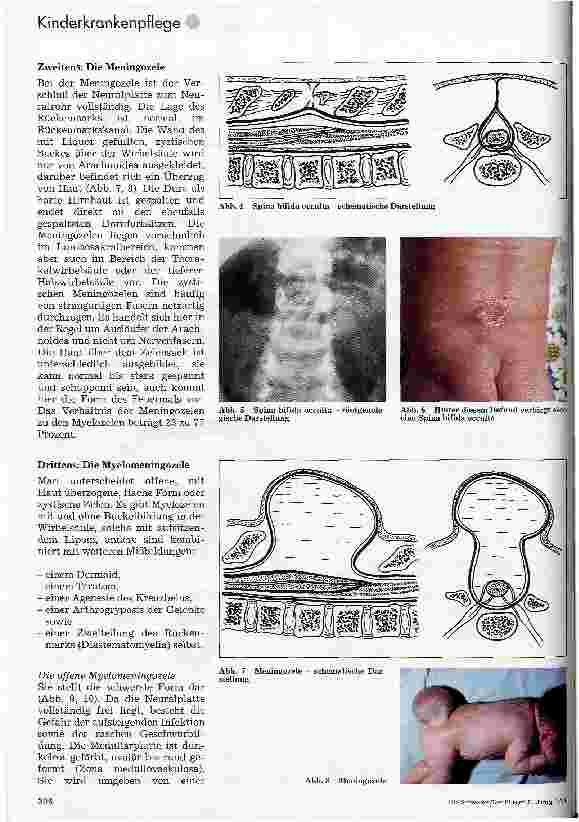 Vorschauseite 3: Kinderchirurgie Teil 2: Mißbildungen der Wirbelsäule und des Rückenmarks