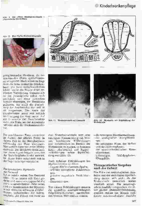 Vorschauseite 4: Kinderchirurgie Teil 2: Mißbildungen der Wirbelsäule und des Rückenmarks
