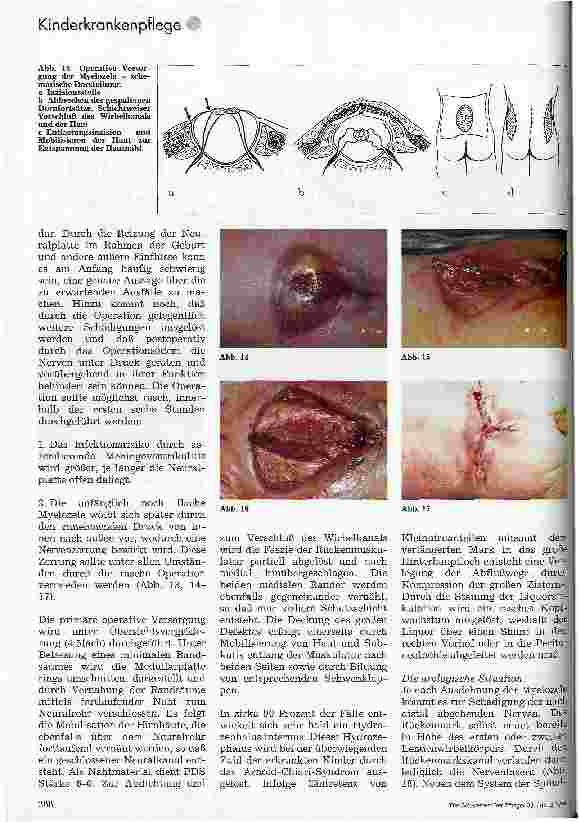 Vorschauseite 5: Kinderchirurgie Teil 2: Mißbildungen der Wirbelsäule und des Rückenmarks