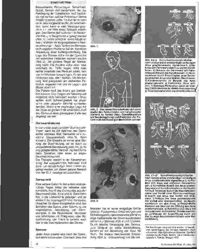 Vorschauseite 2: Das Stoma - Komplikationen und Therapie