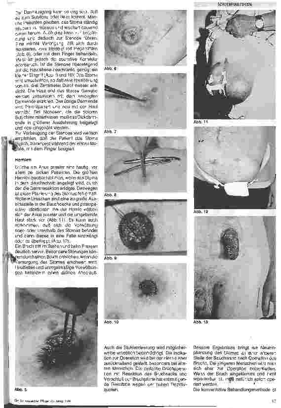 Vorschauseite 3: Das Stoma - Komplikationen und Therapie