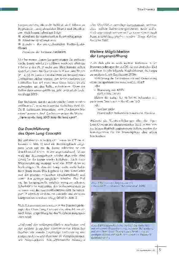 Vorschauseite 2: Open Lung Concept Die Öffnung der Lunge