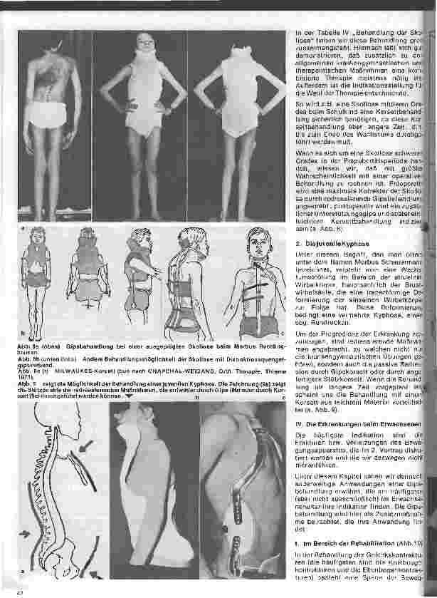 Vorschauseite 3: Moderne Entwicklung in der Orthopädie 2. Teil (Schluß): Gipsanwendung in der Orthopädie