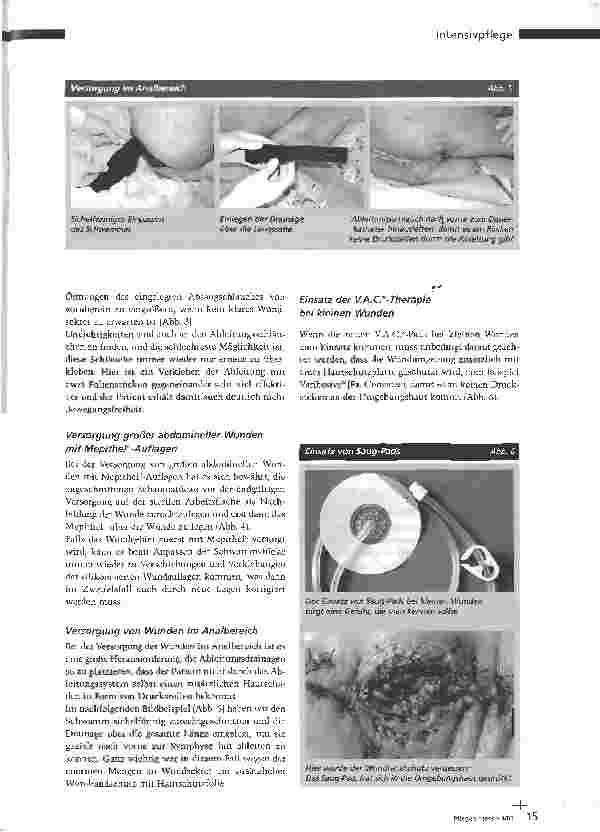 Vorschauseite 4: V.A.C.-Therapie - Wundheilung durch Vakuum
