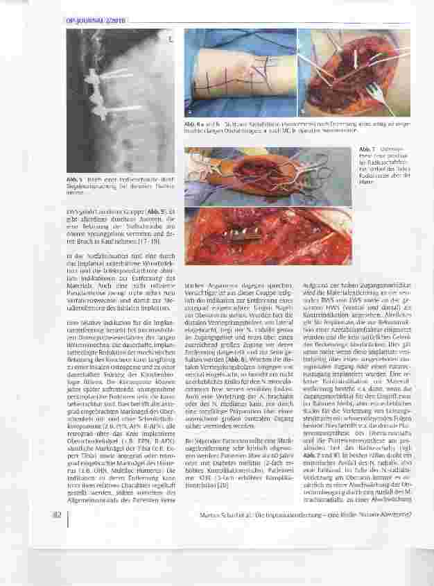 Vorschauseite 3: Die Implantatentfernung - eine Risiko-Nutzen-Abwägung?