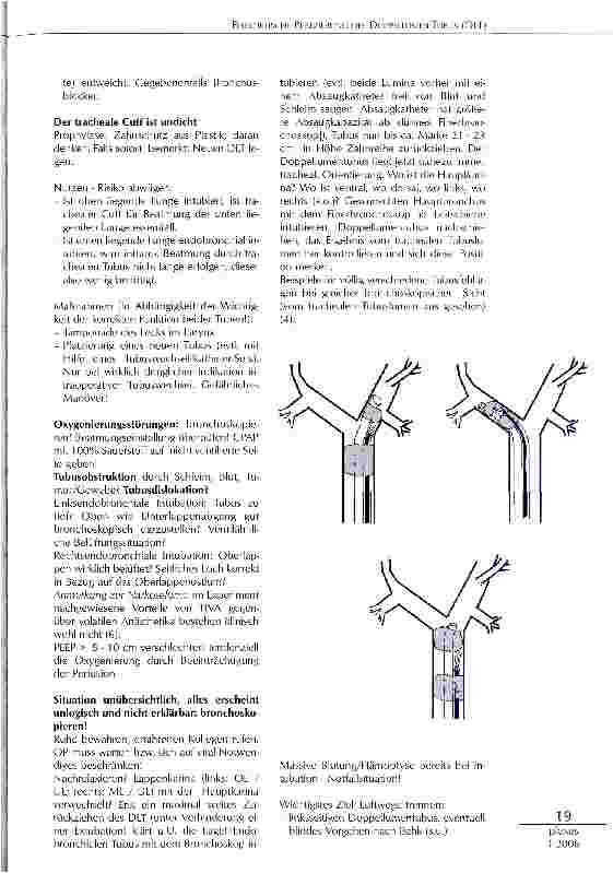 Vorschauseite 4: FIBEROPTISCHE PLATZIERUNG DES DOPPELLUMEN-TUBUS (DLT)