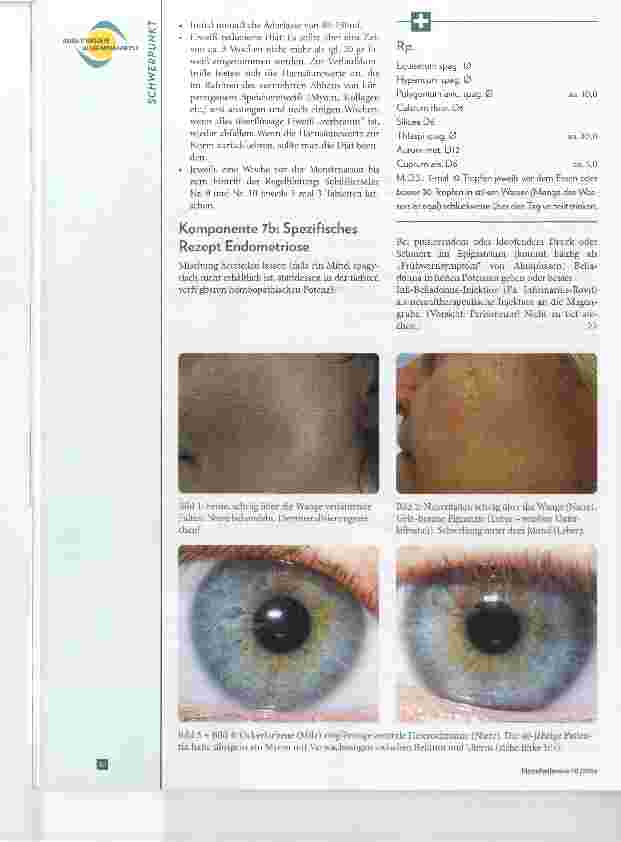Vorschauseite 5: Myome und Endometriose Mithilfe der Augendiagnose erfolgreich behandeln