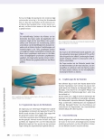 Vorschauseite 6: Narbentherapie am Beispiel der Verbrennungsnarbe