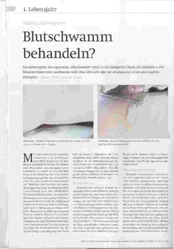 Vorschauseite 1: Infantile Hämangiome Blutschwamm behandeln?