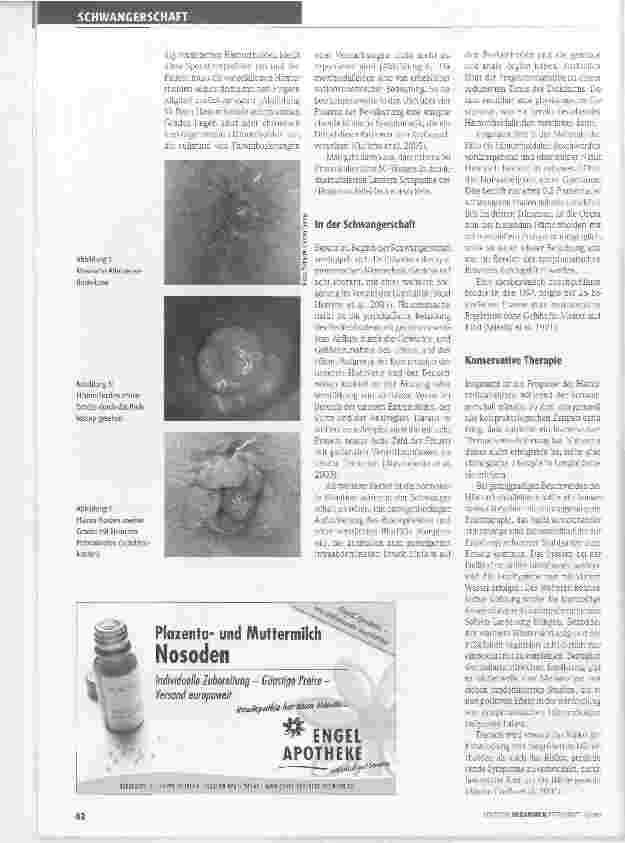 Vorschauseite 2: Hämorrhoiden in Schwangerschaft und Wochenbett