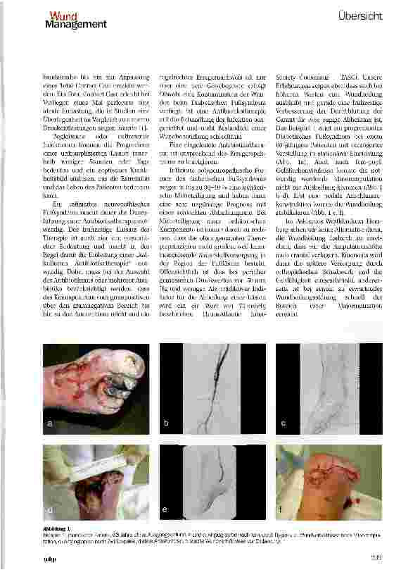 Vorschauseite 4: Das Diabetische Fußsyndrom -Richtige Behandlung durch Verständnis der Pathogenese Diabetic foot syndrome (DFS) —Right treatment through understanding the pathogenesis