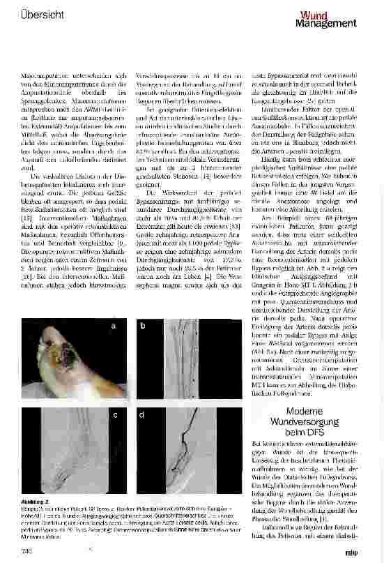 Vorschauseite 5: Das Diabetische Fußsyndrom -Richtige Behandlung durch Verständnis der Pathogenese Diabetic foot syndrome (DFS) —Right treatment through understanding the pathogenesis
