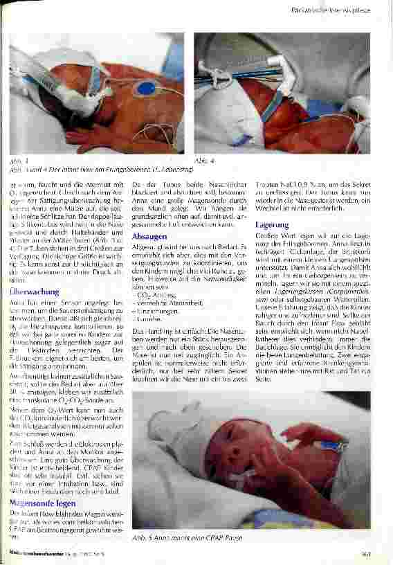 Vorschauseite 2: Nasaler CPAP als Atemhilfe beim kleinen Frühgeborenen - aus pflegerischer Sicht
