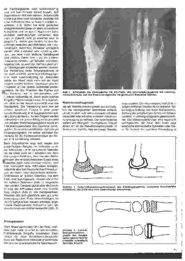 Vorschauseite 2: Rheumatologische Krankheitsbilder 10. Folge (Schluß) Die operative Behandlung der rheumatischen Erkrankungen