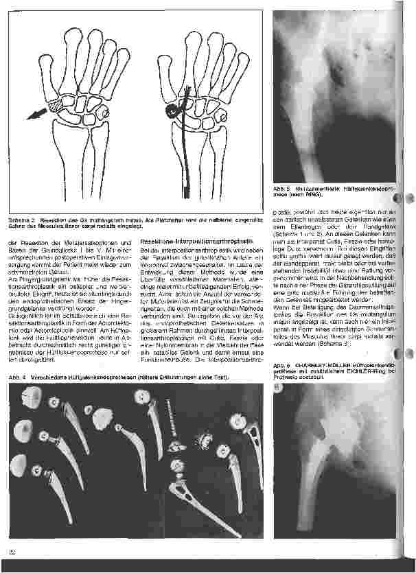 Vorschauseite 3: Rheumatologische Krankheitsbilder 10. Folge (Schluß) Die operative Behandlung der rheumatischen Erkrankungen