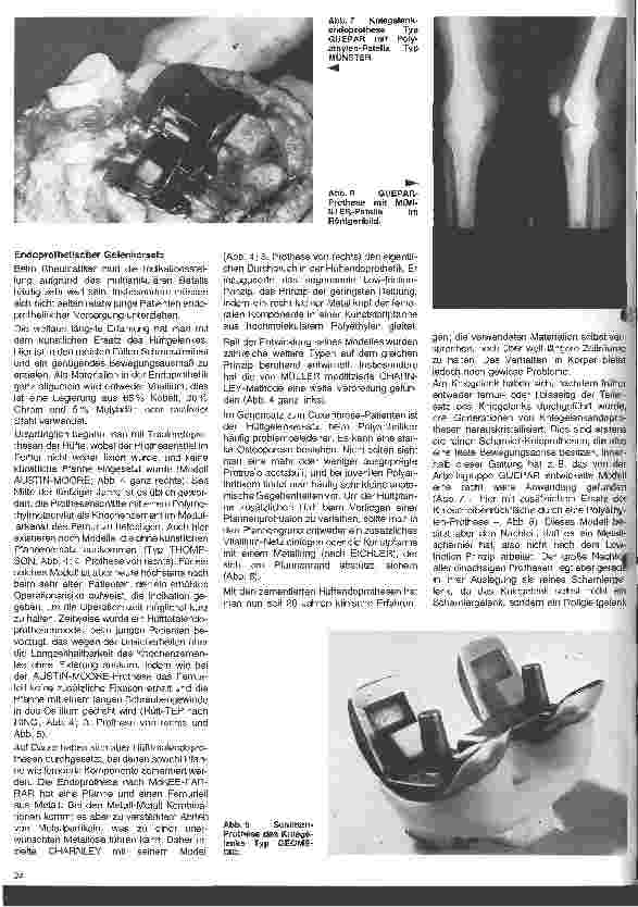 Vorschauseite 4: Rheumatologische Krankheitsbilder 10. Folge (Schluß) Die operative Behandlung der rheumatischen Erkrankungen