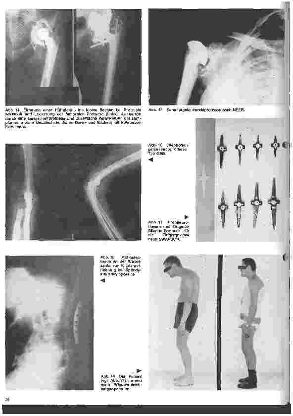 Vorschauseite 6: Rheumatologische Krankheitsbilder 10. Folge (Schluß) Die operative Behandlung der rheumatischen Erkrankungen
