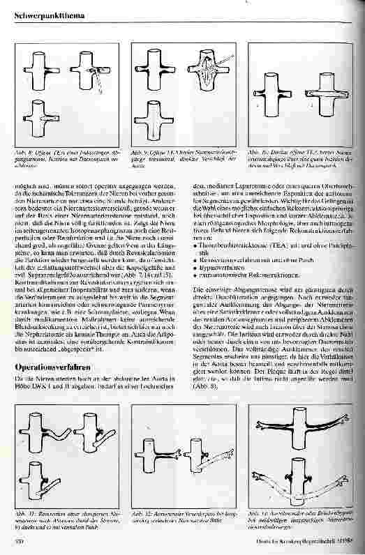 Vorschauseite 5: Renovaskuläre Hypertonie Ein durch Veränderungen der Nierenarterien verursachtes Krankheitsbild und seine Therapie