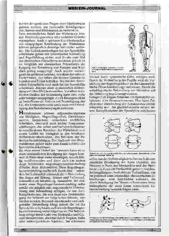 Vorschauseite 2: Über den sogenannten Morbus Bechterew (Spondylitis ankylosans), eine chronisch entzündliche Wirbelsäulenerkrankung