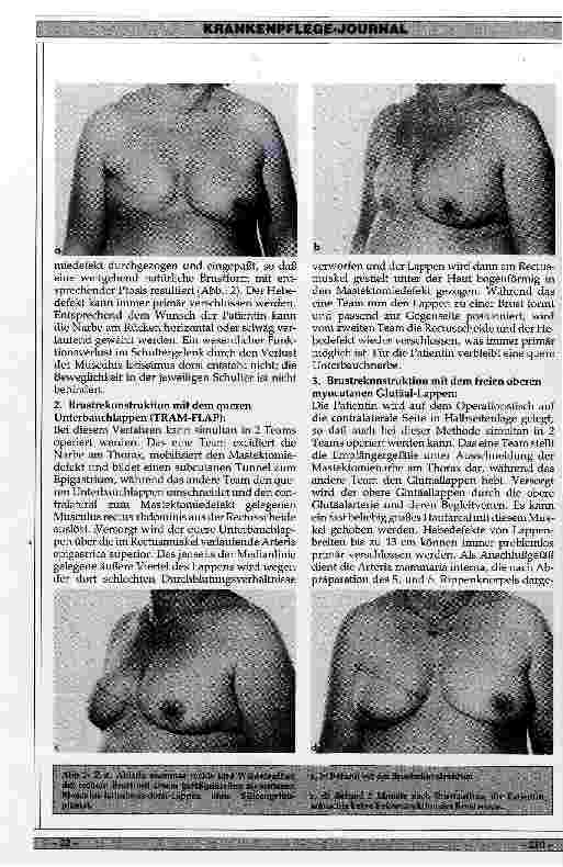 Vorschauseite 3: Möglichkeiten der plastischen Chirurgie zur Rekonstruktion der Mamma nach Karzinomenentfernung