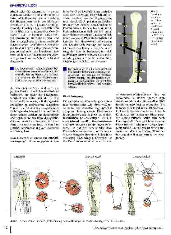 Vorschauseite 3: Sachgerechte Anwendung und Komplikationsmanagement beim Fixateur externe