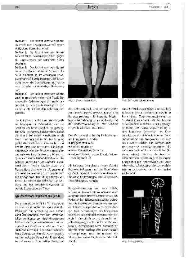 Vorschauseite 2: Deformitäten des rheumatischen Kniegelenks (Teil II)
