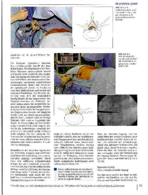 Vorschauseite 4: Vollendoskopische Operationen der Wirbelsäule bei Bandscheibenvorfall und Spinalkanalstenose