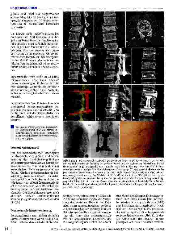 Vorschauseite 3: Instrumentierung und Fusion nach thorakalem und lumbalem Trauma