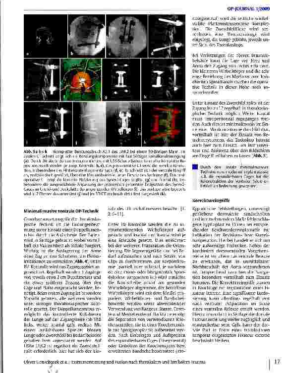 Vorschauseite 6: Instrumentierung und Fusion nach thorakalem und lumbalem Trauma