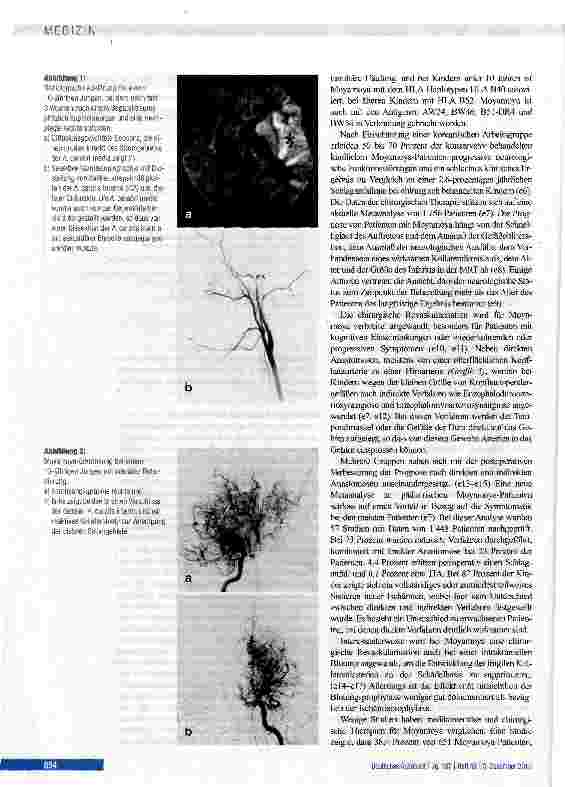 Vorschauseite 4: Zerebrale Angiopathien als Ursache von ischämischen Schlaganfällen im Kindesalter