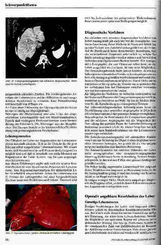 Vorschauseite 4: Möglichkeiten und Grenzen der Leberchirurgie