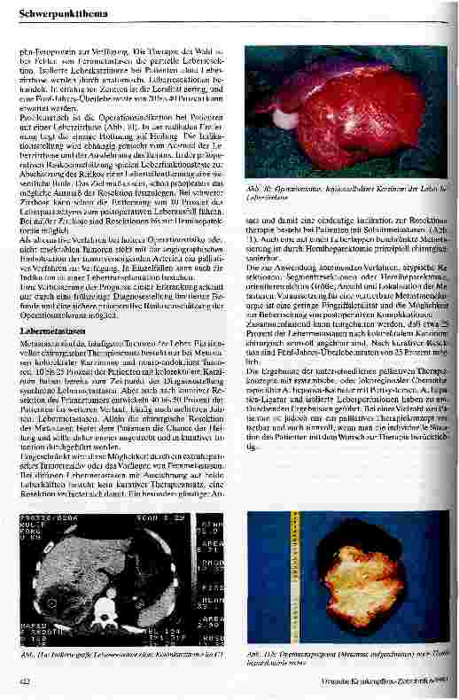 Vorschauseite 6: Möglichkeiten und Grenzen der Leberchirurgie