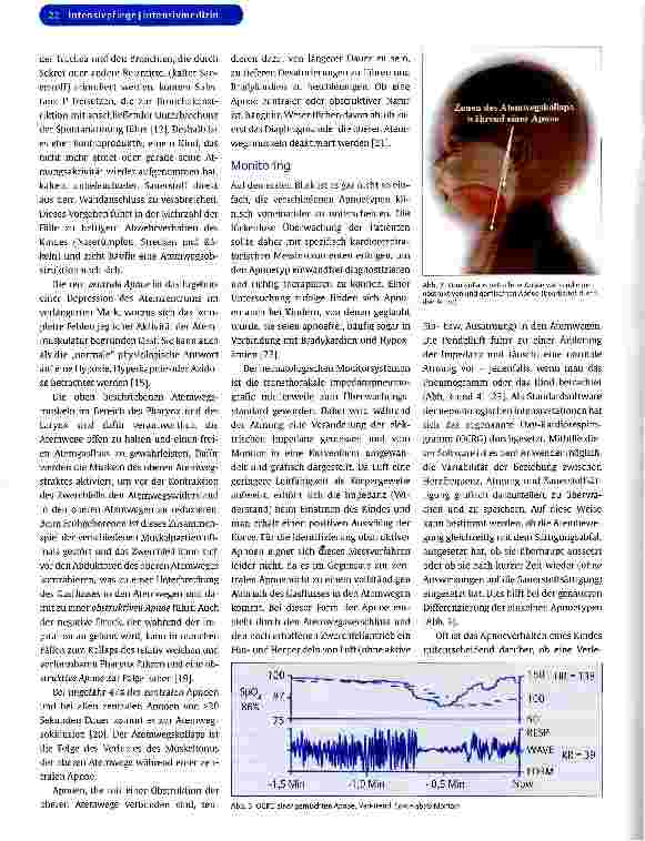Vorschauseite 4: Das Apnoe-Bradykardie-Syndrom des Frühgeborenen