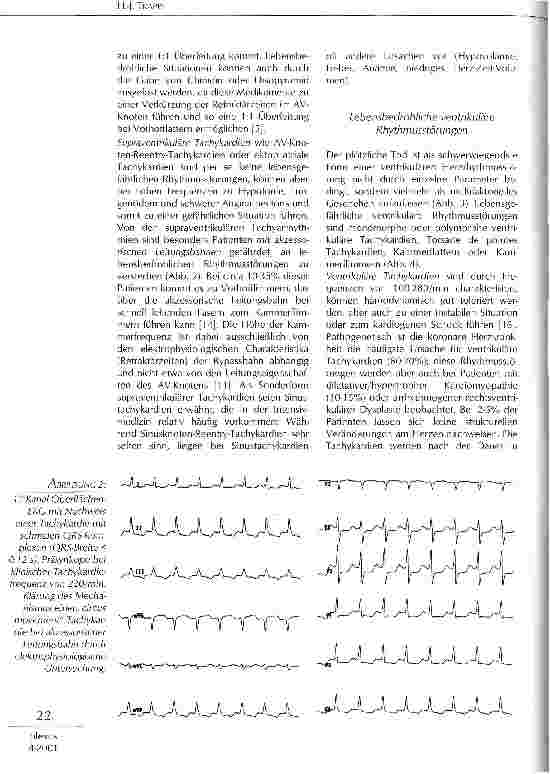 Vorschauseite 3: Supraventrikuläre und ventrikuläre Rhythmusstörungen in der Intensivmedizin
