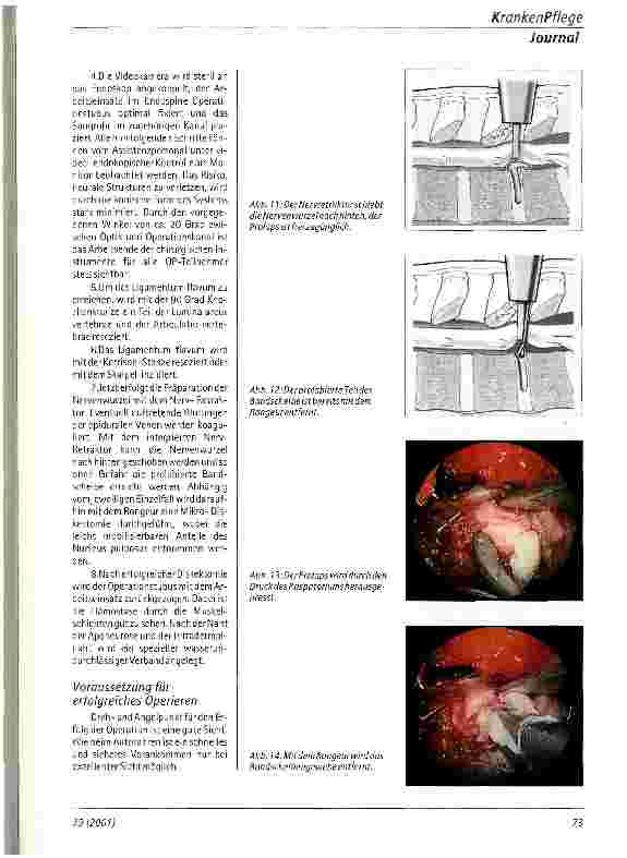 Vorschauseite 4: Endoskopische minimalinvasive Therapie des lumbalen Bandscheibenvorfalls