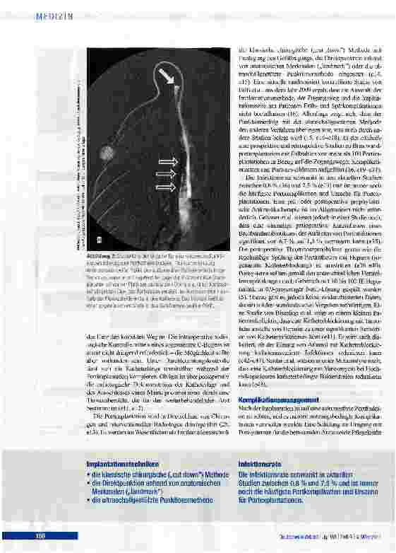 Vorschauseite 4: Portsysteme als integraler Bestandteil von Chemotherapien