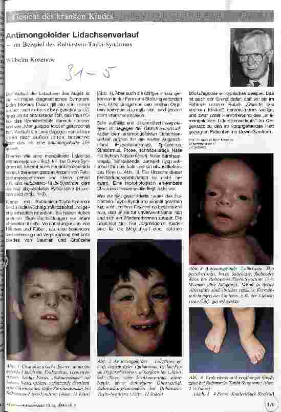 Vorschauseite 1: Antimongoloider Lidachsenverlauf