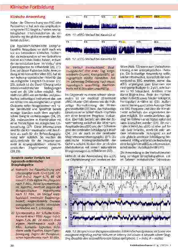 Vorschauseite 5: Die amplitudenintegrierte Elektro-enzephalographie (aEEG) bei Frühund Neugeborenen - eine Übersicht